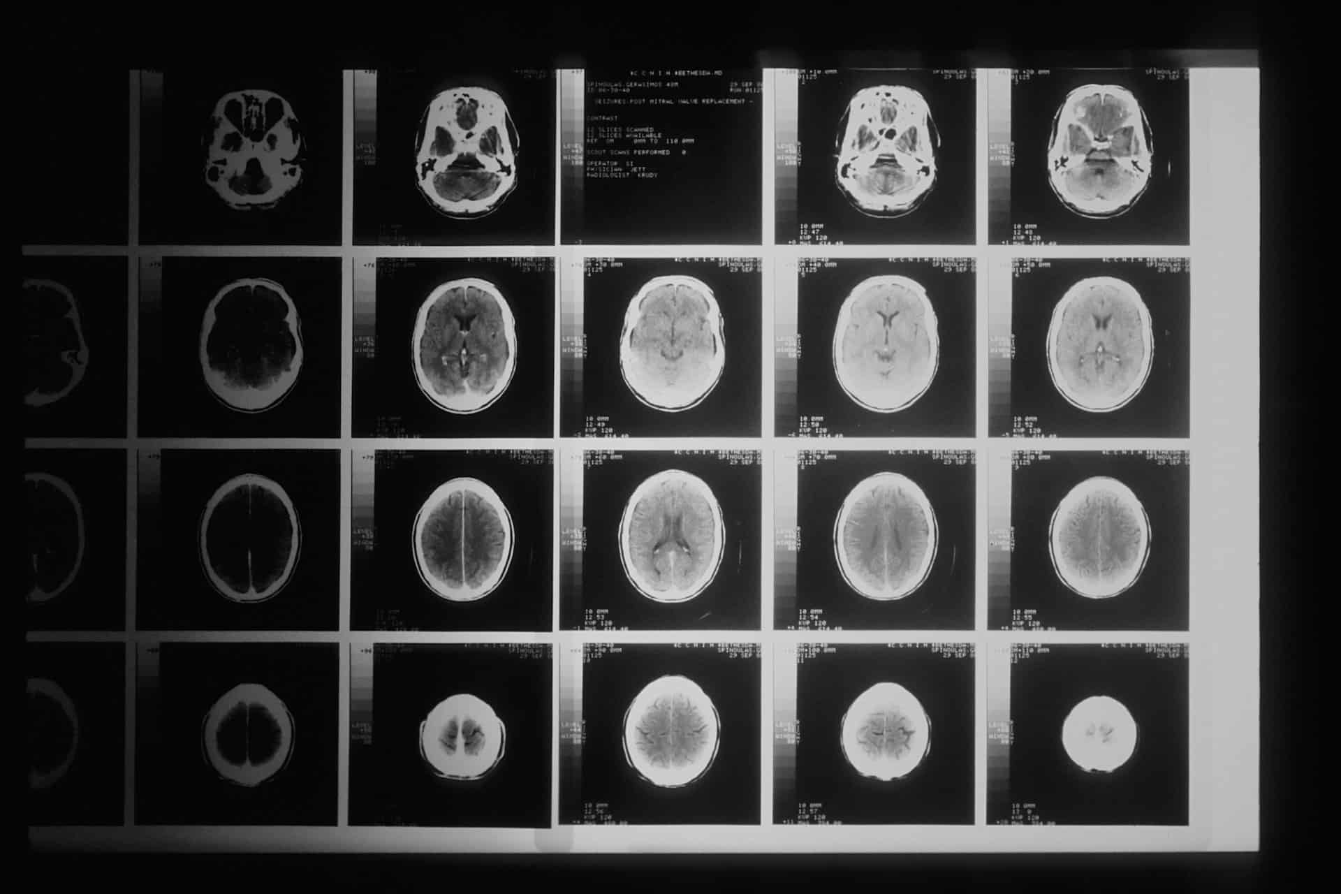 x-ray photo of brain scan