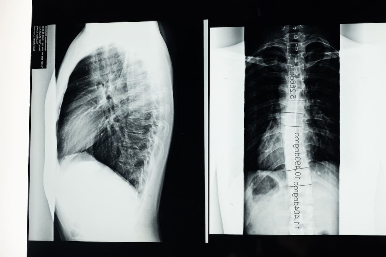 x-ray image of spine