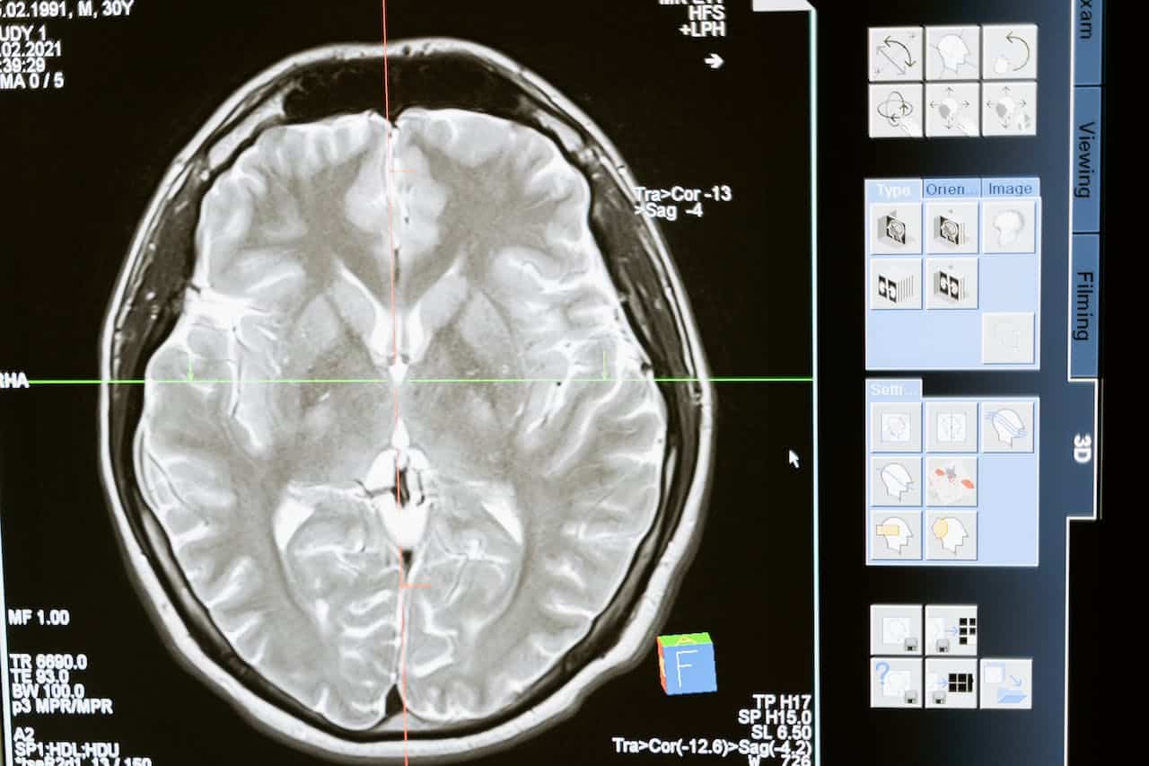 MRI scan of brain